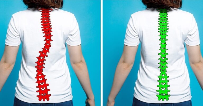 precvicovanie-tychto-cvikov-len-10-minut-denne-vam-pomoze-zbavit-sa-skoliozy