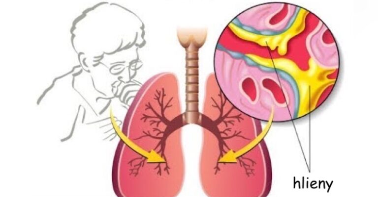6-prirodnych-receptov,-ktore-vam-pomozu-rychlo-sa-zbavit-hlienov-z-hrdla,-nosa-ci-priedusiek