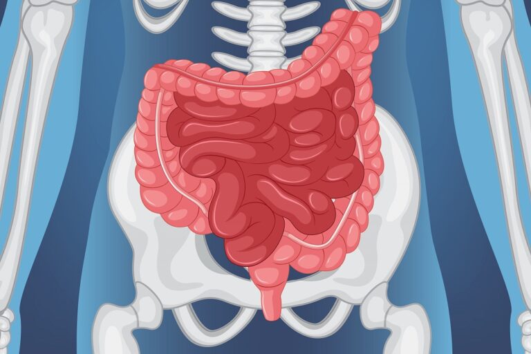 rozsirene-tluste-strevo-komplikuje-drazdivy-tracnik.-hrozi-prasknuti